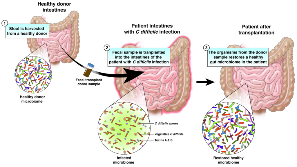 Fecal Microbiota Transplantation